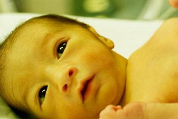 benh vang da o tre so sinh - Những điều cần biết về bệnh vàng da ở trẻ sơ sinh